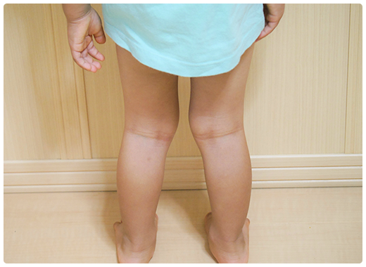 O脚・X脚改善コース